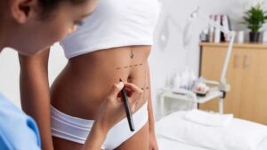 Liposuction