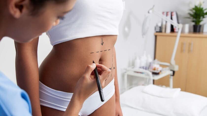 Liposuction