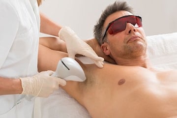 permanent hårborttagning malmö