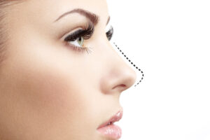 Rhinoplasty