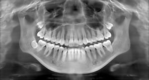 Dental X-Ray Market