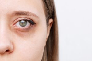 How Dark Circles Treatment Improves Skin Texture