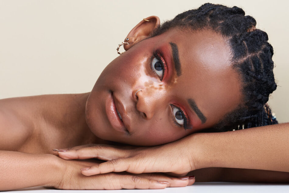 How Does Vitiligo Treatment Restore Skin Pigment