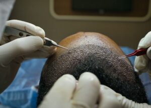 How the Best Hair Transplant Improves Confidence