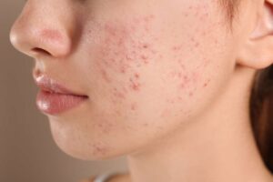 Innovative Solutions for Persistent Acne