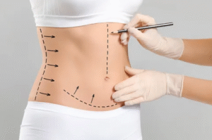 Liposuction Surgery in Dubai