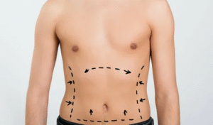 Liposuction in Dubai