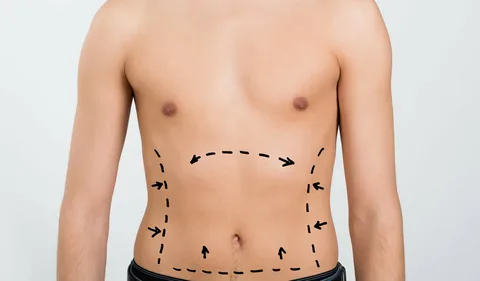 Liposuction in Dubai