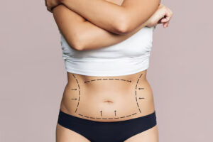 Liposuction in Islamabad