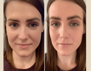 Prp Treatment in Dubai