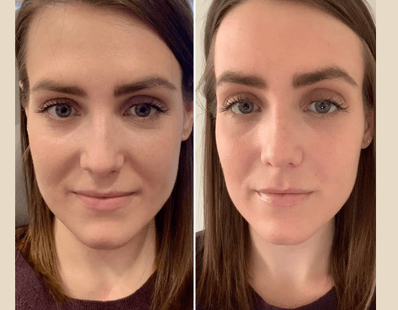 Prp Treatment in Dubai