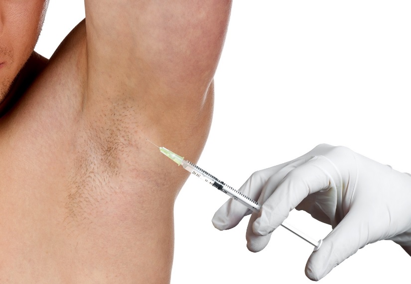 Sweat-Free Confidence with Botox