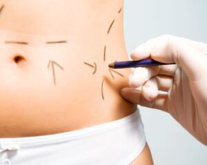 Tummy Tuck