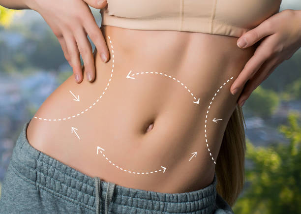 What Makes Liposuction the Go-To for Body Sculpting