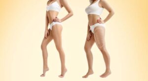 Liposuction surgery Dubai