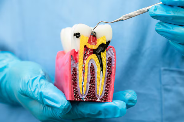 root canal treatment bowling green ky