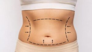 Tummy Tuck