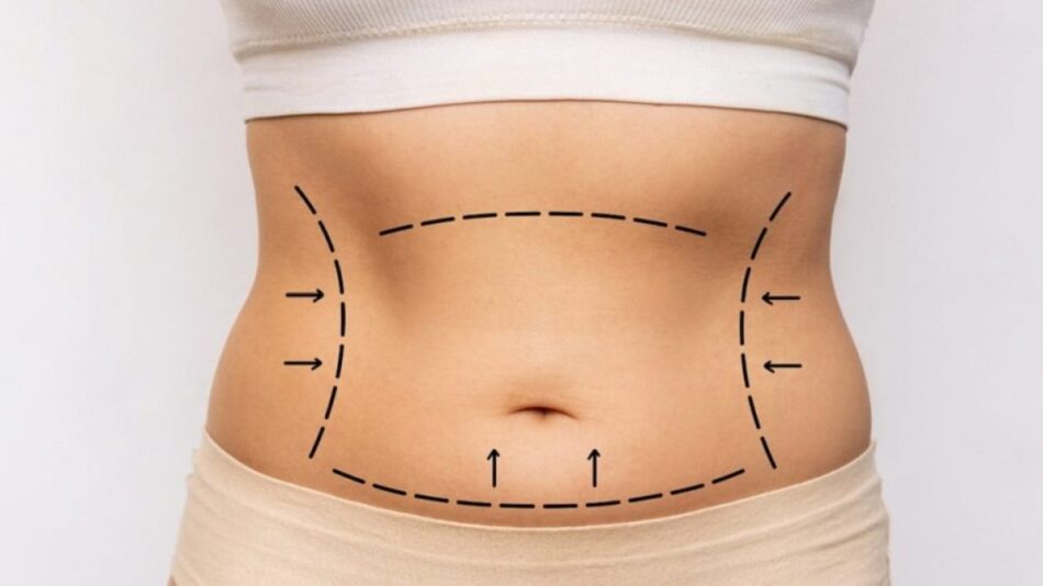Tummy Tuck