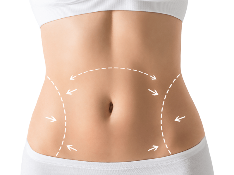 Tummy Tuck