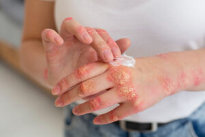 Eczema & Psoriasis Treatment Dubai