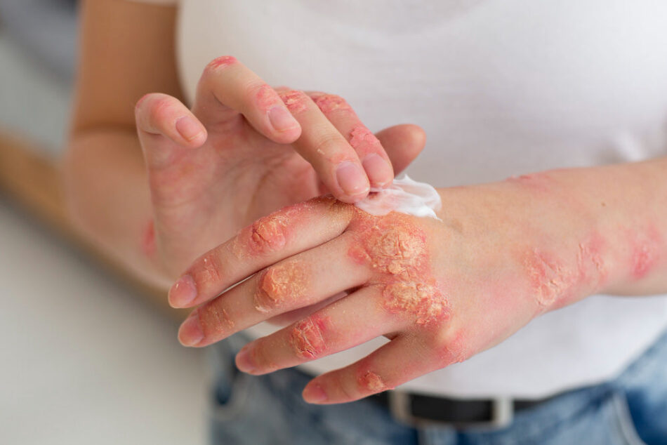 Eczema & Psoriasis Treatment Dubai