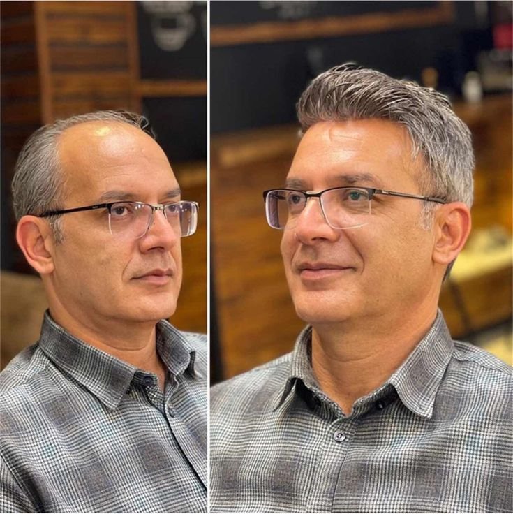 hair replacement system