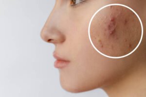 Best Dermatologist For Acne Treatment In Dubai