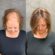 hair loss women Lacey