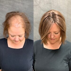 hair loss women Lacey