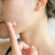 Acne Scar Treatment in Dubai