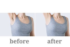 Armpit Peeling in Dubai