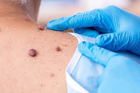 Mole Removal in Dubai