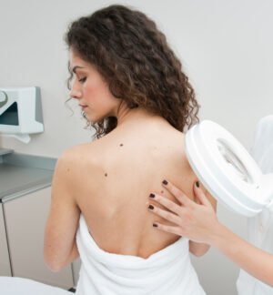 Mole removal in Islamabad
