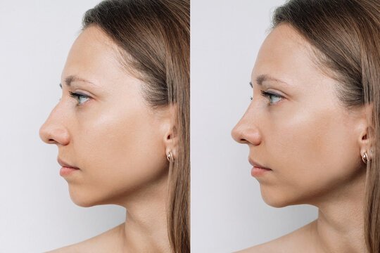 Rhinoplasty Cost in Pakistan
