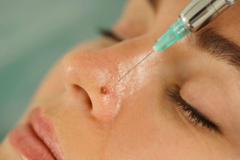 Warts Removal in Islamabad.