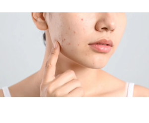 Who is a Good Candidate for Acne Treatment?