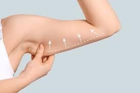 arm lift surgery