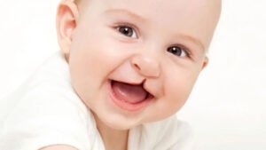 cleft lift and palate surgery