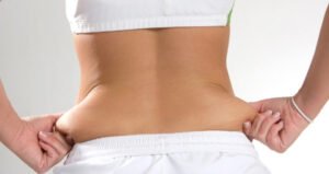 high def liposculpture