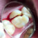 same day root canal