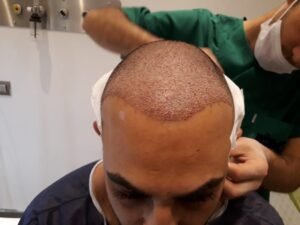 Hair Transplant in Dubai