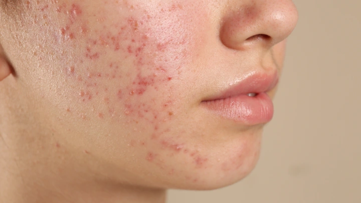 Can Large Pores Treatment improve overall skin quality