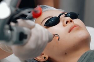 Pico Laser Treatment in Dubai