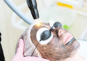 Spectra Laser Carbon Peel islamabad