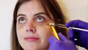 Under Eye Fillers in Dubai