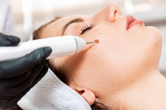 What are the latest Moles Removal techniques?