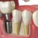 dental implant in isl