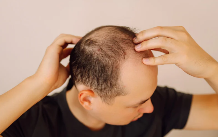 Hair loss