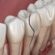 fractured teeth treatment