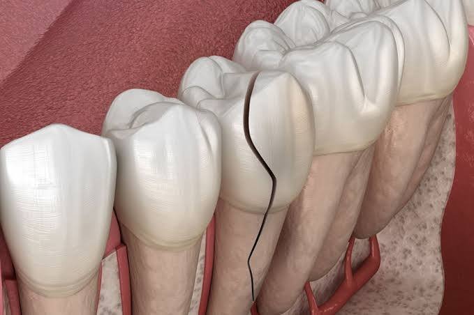fractured teeth treatment